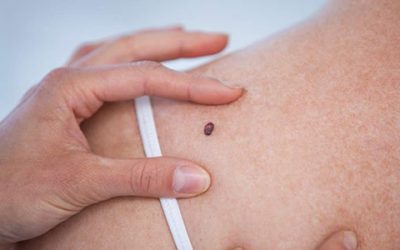 Melanoma világnapja – előzd meg szűréssel a melanoma kialakulását